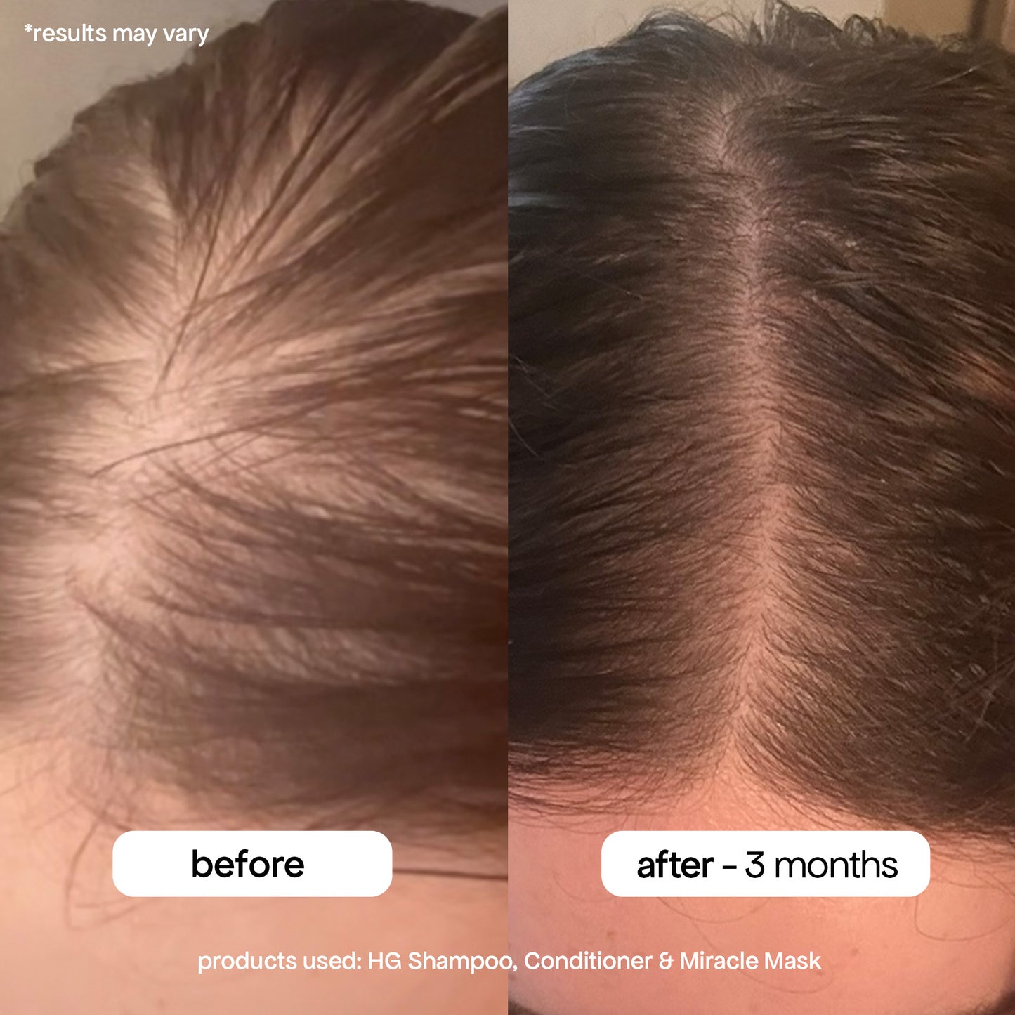 ANTI-THINNING BUNDLE TO BOOST YOUR ROOTS - TIKTOK EXCLUSIVE