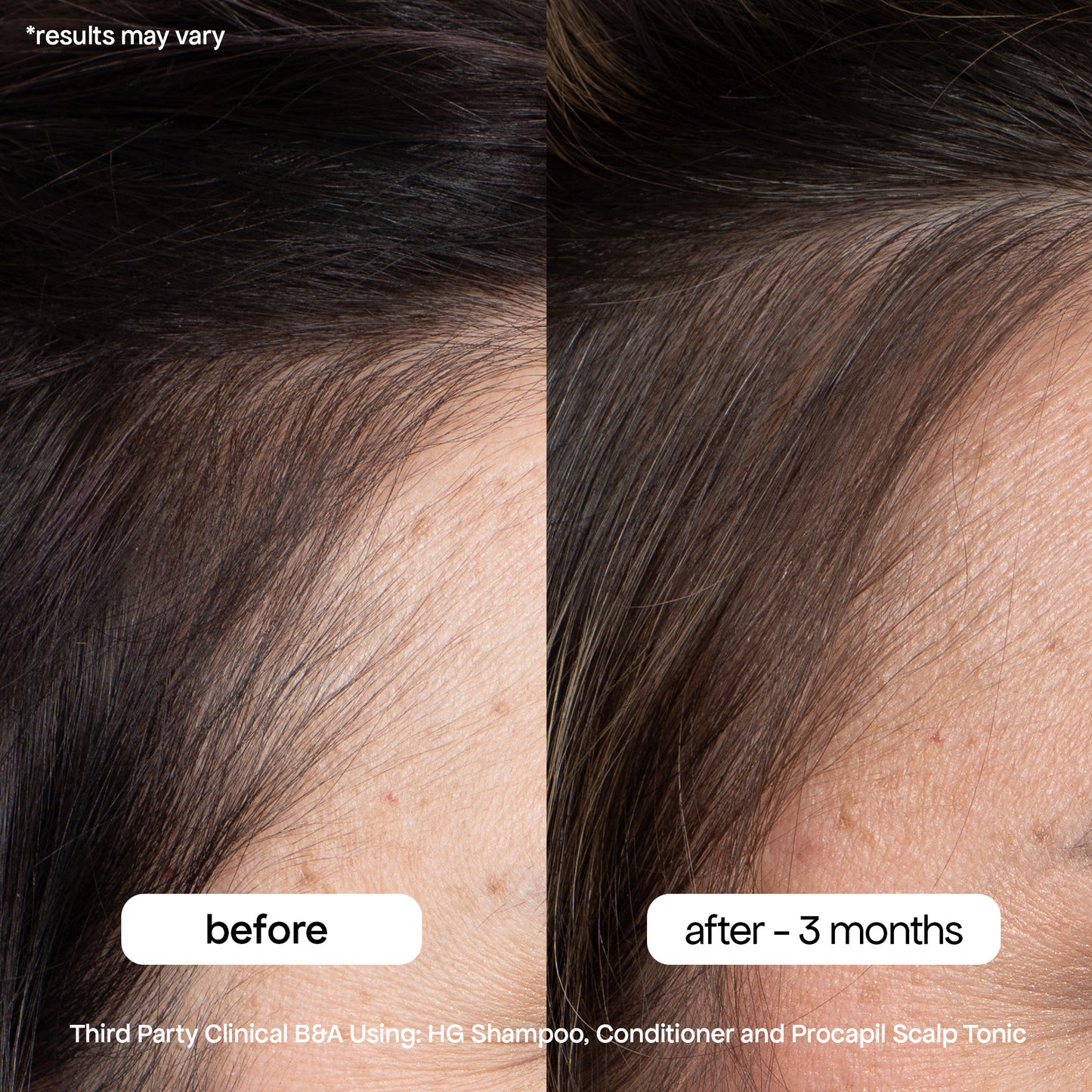 ANTI-THINNING BUNDLE TO BOOST YOUR ROOTS - TIKTOK EXCLUSIVE