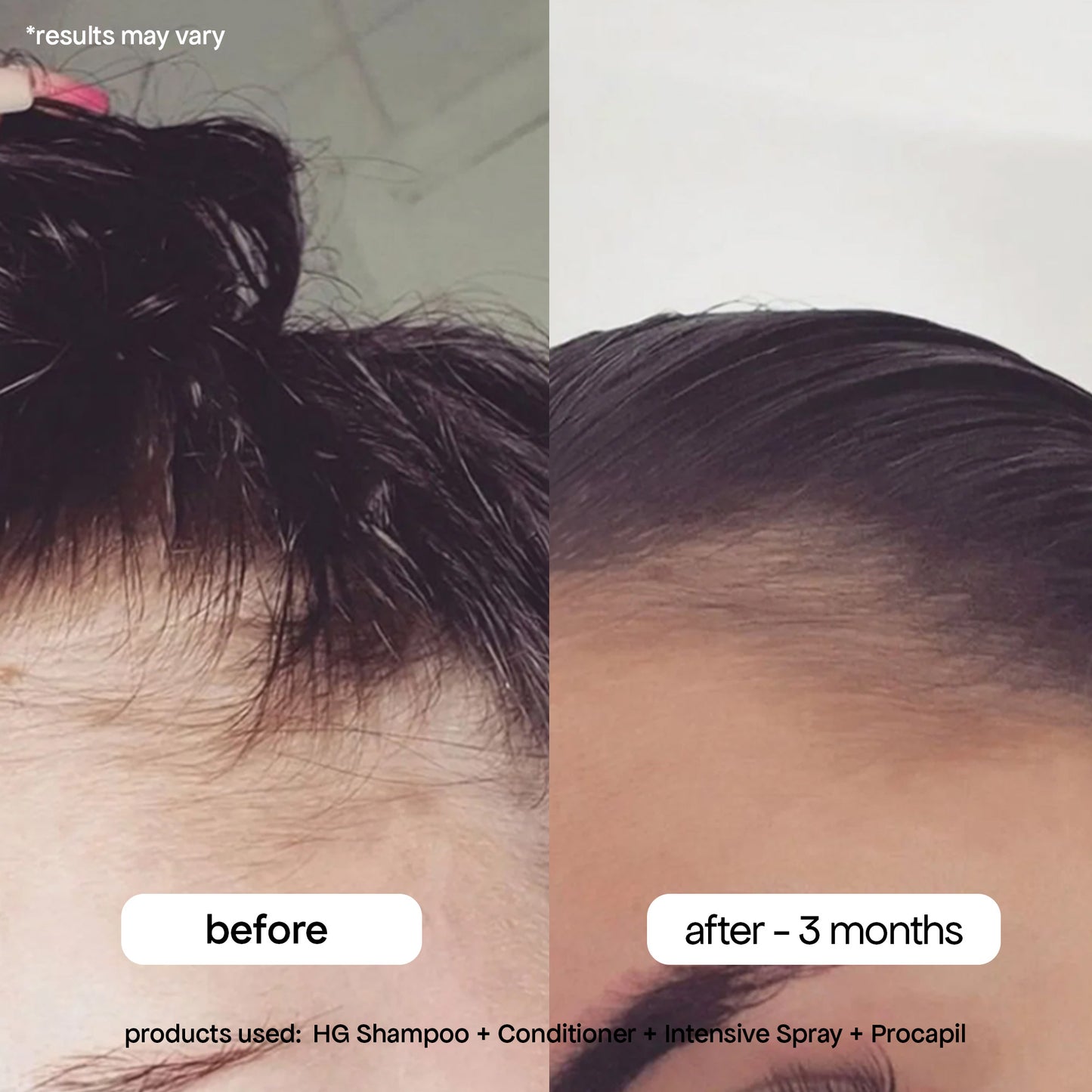 ANTI-THINNING BUNDLE TO BOOST YOUR ROOTS - TIKTOK EXCLUSIVE