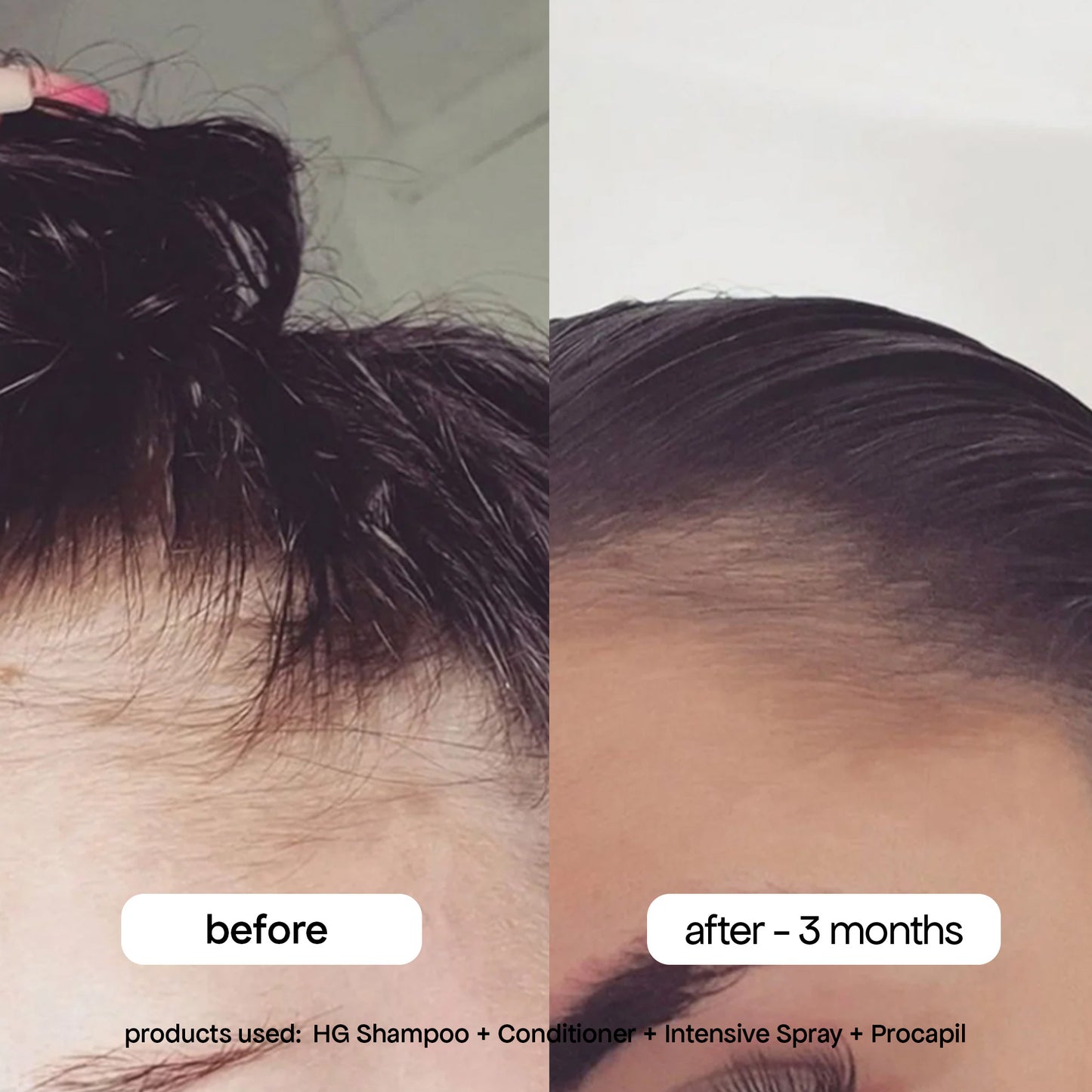 ANTI-THINNING PROCAPIL® SCALP TONIC